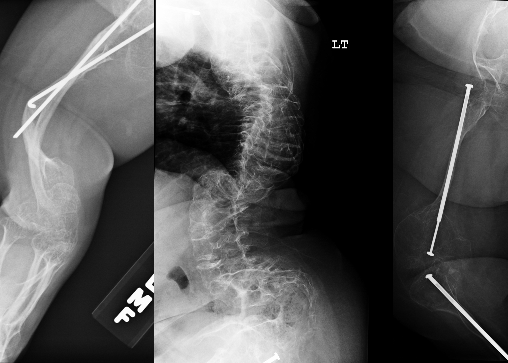 Osteogenesis Imperfecta 101